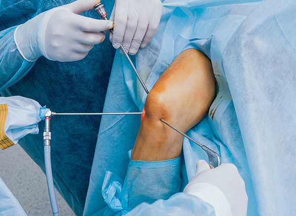 Arthroscopy