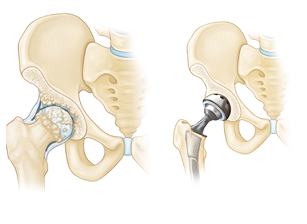 Joint replacements