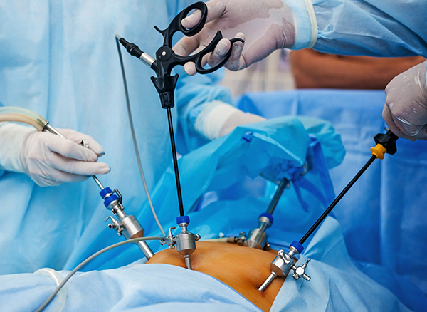 Laproscopic Surgergy